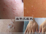尿毒癥+咳嗽+癡呆+子宮肌瘤+乙肝+尿潴留+暈車+扁平疣+心臟病