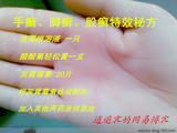 【轉(zhuǎn)載】手癬腳癬秘方