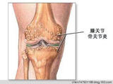 【轉(zhuǎn)載】骨性關(guān)節(jié)炎的預(yù)防措施==“針刀松解術(shù)”治療骨性關(guān)節(jié)炎